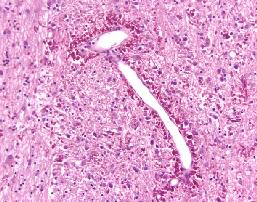 Alexander Disease image